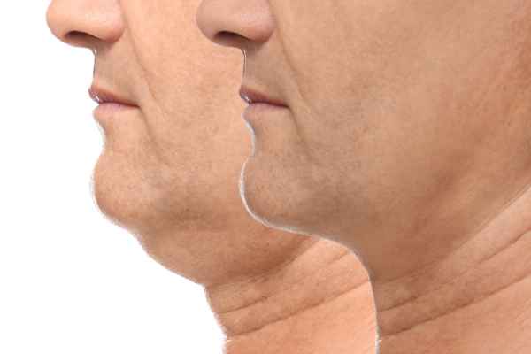 HIFU - Breakthrough in Anti - ageing 2 hifu results Wealdstone