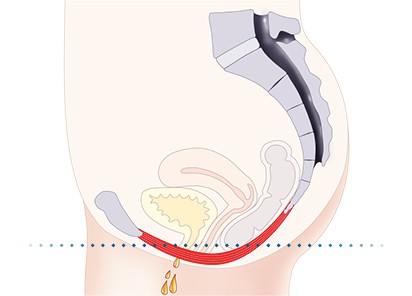 Pelvic-Floor Muscle Repair 5 Pelvic floor muscles Wealdstone