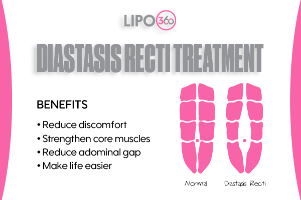 Revolutionising Muscle Repair: The Power of LIPO360 Body Sculpt Post-Injury 5 diastasis recti treatment Wealdstone