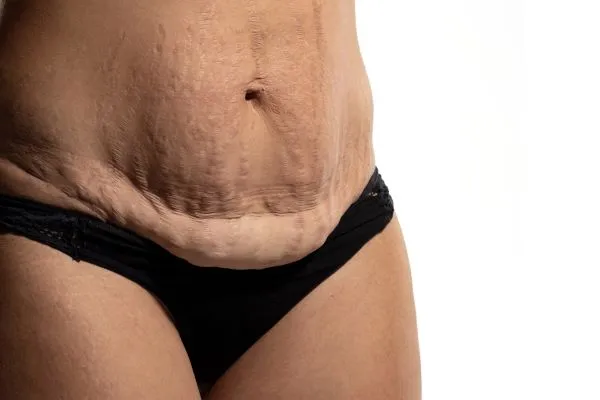 The Science of Skin Tightening 1 The science behind skin tightening Wealdstone picture of a woman's sagging skin on the stomach